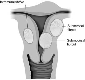 Fibroid Types