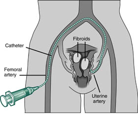 Uterine Artery Embolization